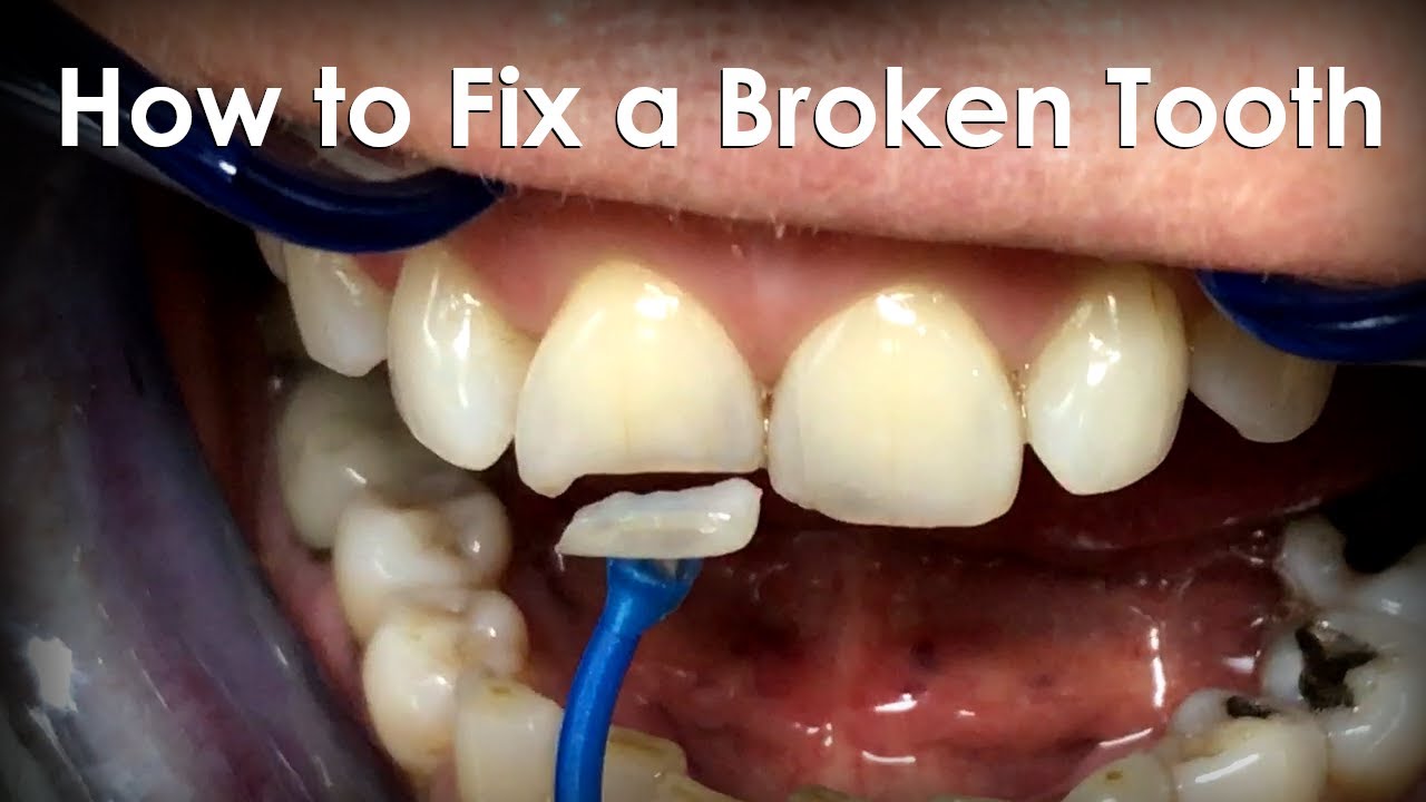 How to Repair a Cracked Tooth at Home: A Comprehensive Guide